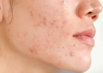 How To Remove Acne Scars?