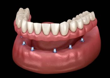 How To Transition From Traditional Dentures To Dental Implants