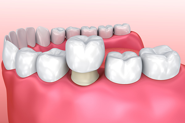Fillings, Crowns, And More: Common Restorative Treatments In General Dentistry